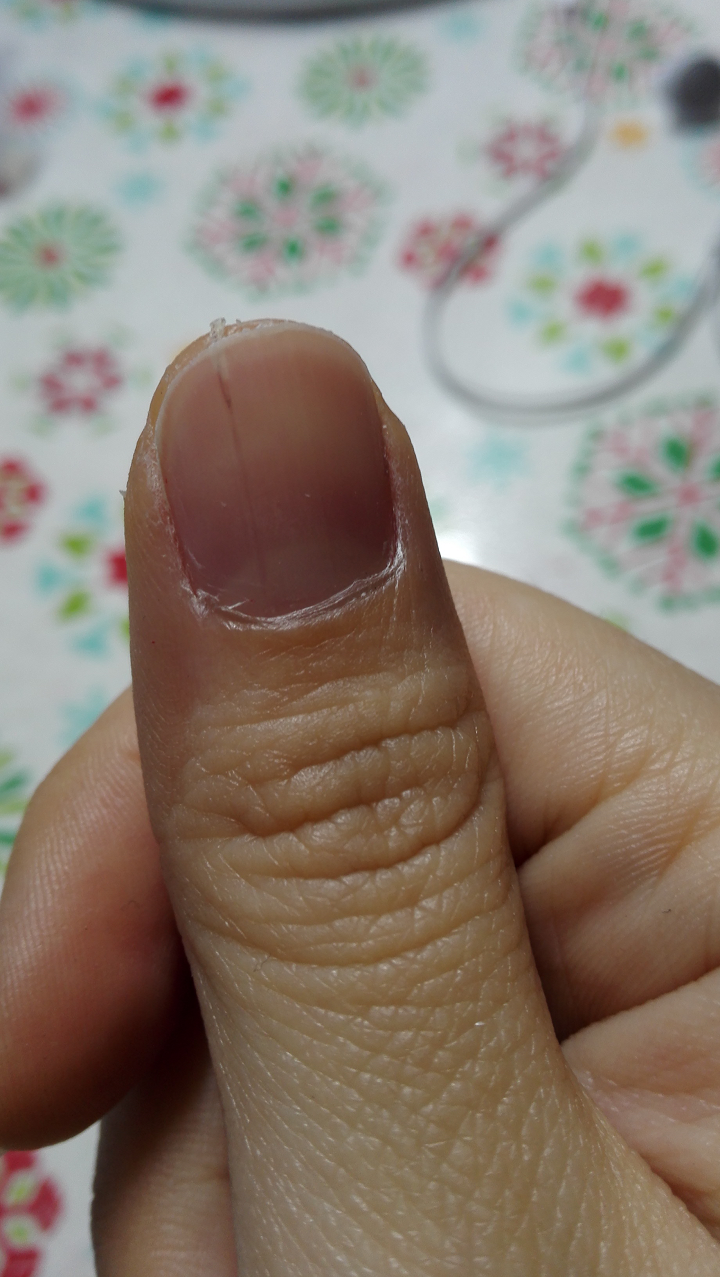 手指甲中间有一条纵线是怎么回事?
