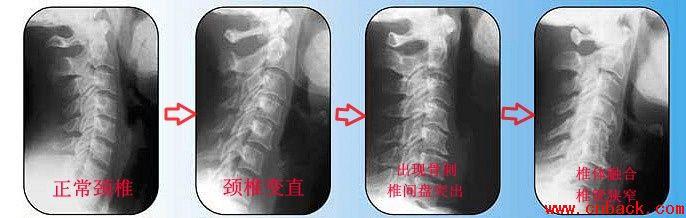 程序员、白领如何保护自己的颈椎 程序员、白领如何保护自己的颈椎