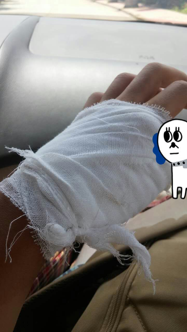 被100°c的开水烫到是一种什么样的经历?