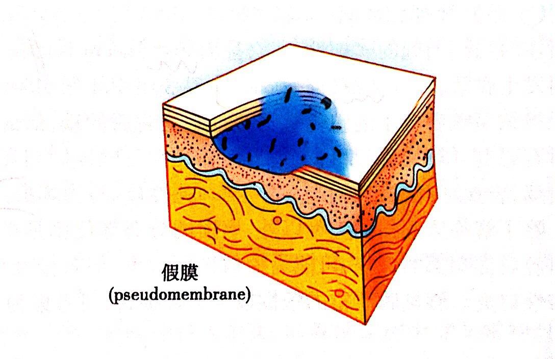 撕去假膜,一方面便于 病损区对药物的直接接触和吸收,另一方面 减少了