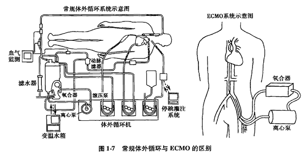 更重要的是,ecmo 费用极高,一般都是六位数.