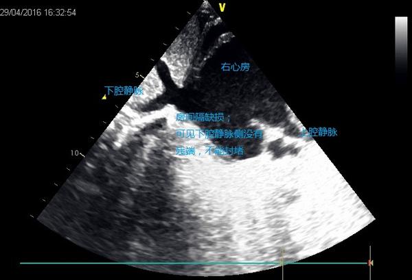 就是上面说的,腔静脉型,混合型和冠状静脉窦型不能做.