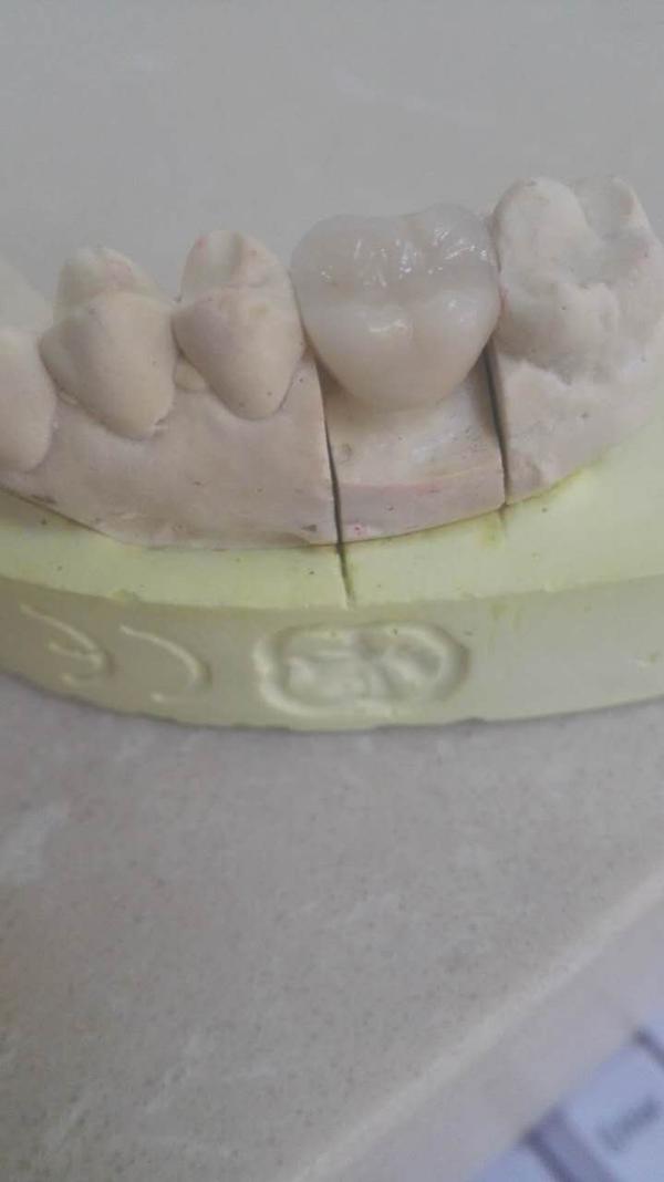 磨牙根管治疗后,崩裂一小块,为什么呢?