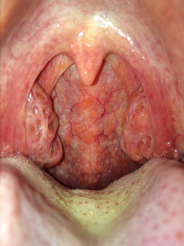 注意图中扁桃体前后的两圈膜,前边一圈连着小舌头的叫 腭舌弓,后边一