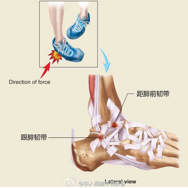 崴脚的受伤原理是什么?