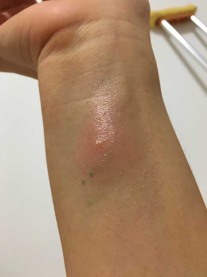 拥有一个容易被蚊子咬的体质是一种怎样的体验?