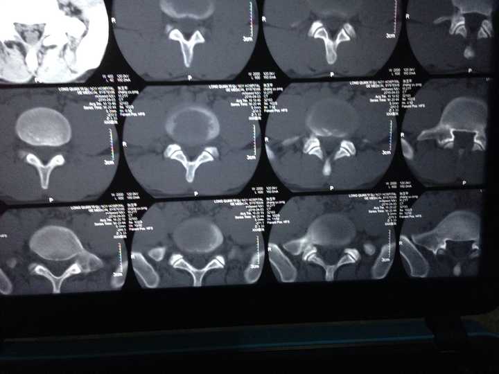 腰椎间盘突出05cm压迫硬膜囊现在已经针灸半个月左腿和屁股好痛啊弯腰