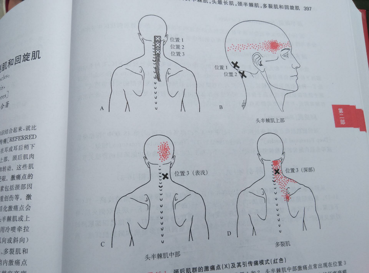 出所以然,许多医生也没有这个概念,特别是疼痛区域在头顶和前额以及