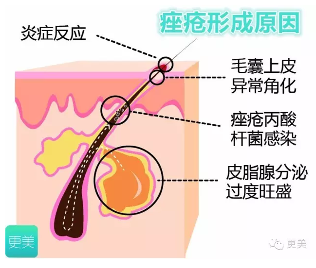 果酸能从源头抑制痤疮,改善皮脂腺增生导致的出油过于旺盛,毛孔堵塞