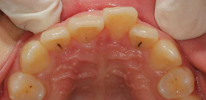 为什么许多人上颌的侧切牙是歪的?