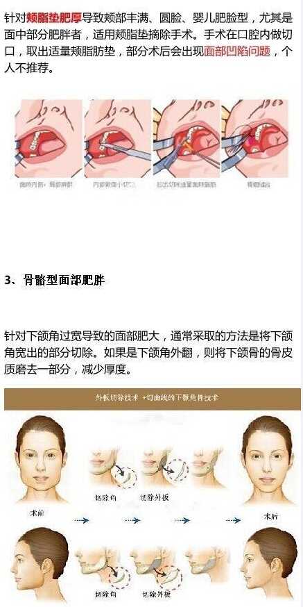 瘦脸针是不是用来减小咬肌的可是我就是脸上胖胖的是脂肪打瘦脸针有用