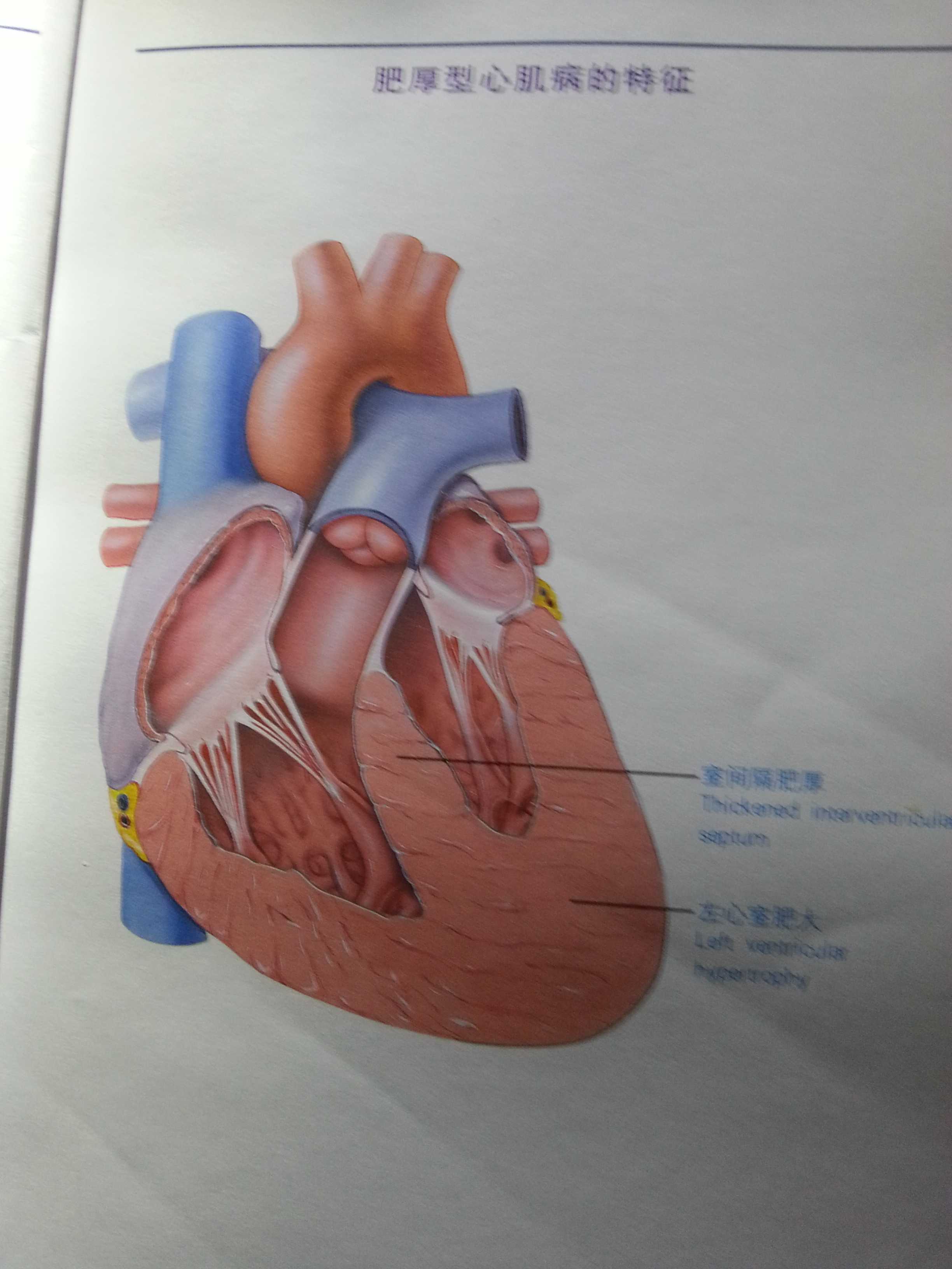 1.梗阻机制:左室流出道梗阻在收缩期,肥厚的心肌使心室流出道狭窄.