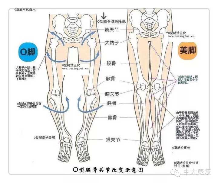 x型腿就是磨损外侧的半月板,普通的o型腿就是股骨外旋,胫骨内旋(看不