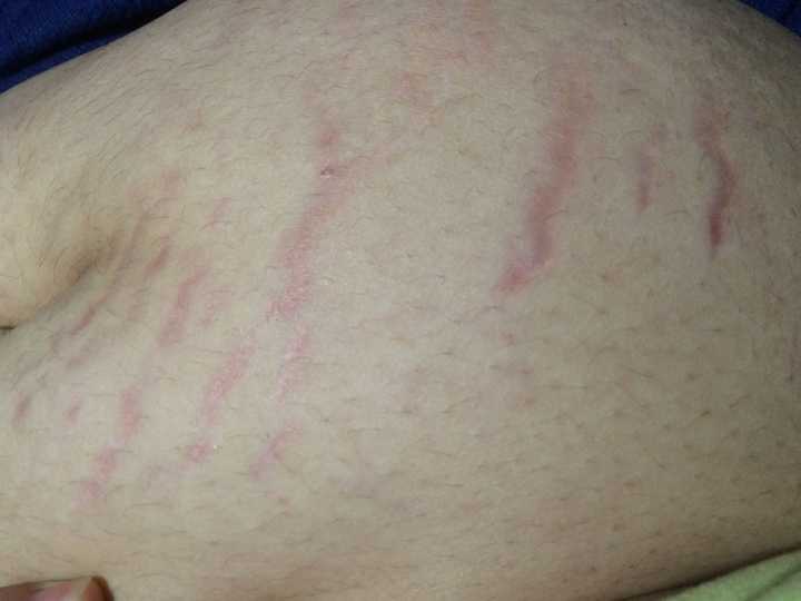 肥胖纹到底是瘦了还是胖了?