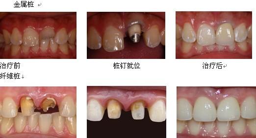 口腔牙体修复中,桩冠和桩核冠的区别?