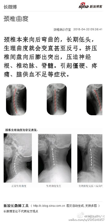 颈椎生理曲线变直?