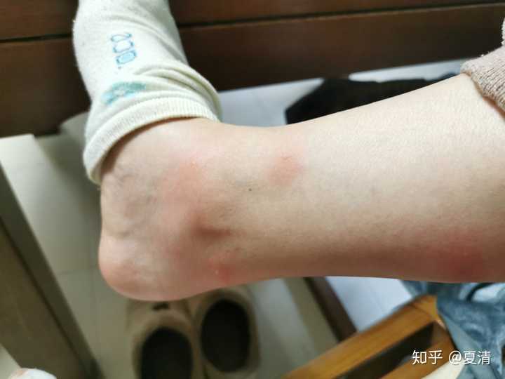 和我的比起来前面都不算什么 超大面积巨可怕的丘疹性荨麻疹哈哈
