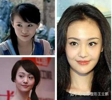 隆鼻,瘦咬肌,去泪沟,变得越来越精致,想传爽妹子已经取了填充的假体