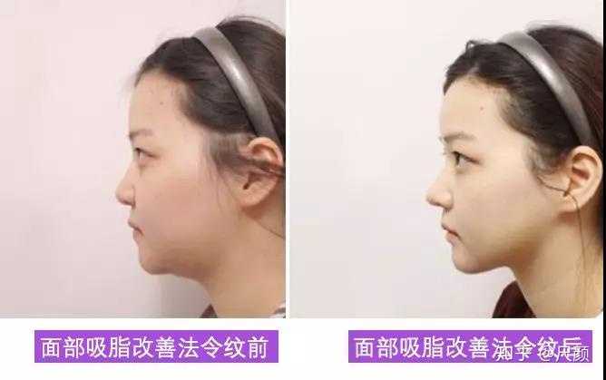 具体面部吸脂部位和吸脂量,也需要由专业医生当面面诊后制定.