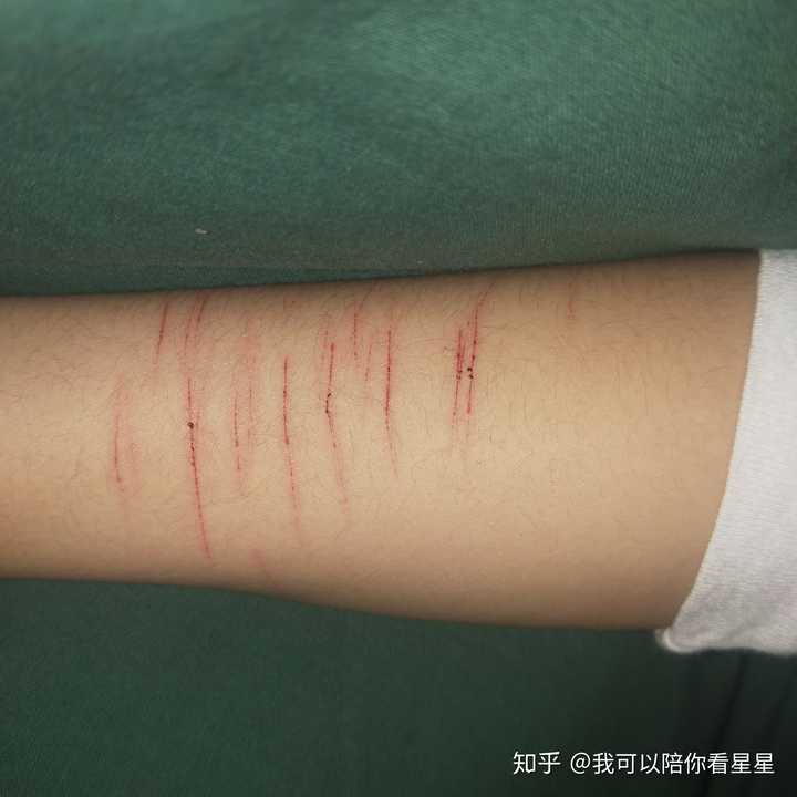 自残的人在自残后会后悔吗?
