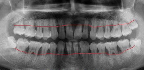 我们可以看到,正常人的牙槽骨高度大概位于牙齿牙颈部的位置,这个高度