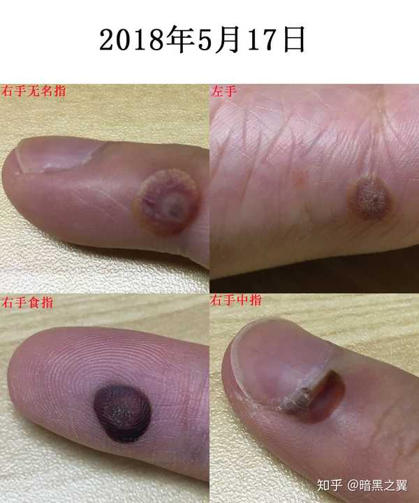 怎么治瘊子?