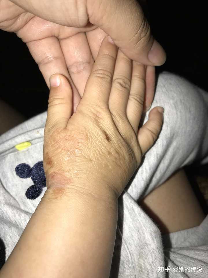 被隐翅虫咬了怎么治?让他自己好?还是要看医生?