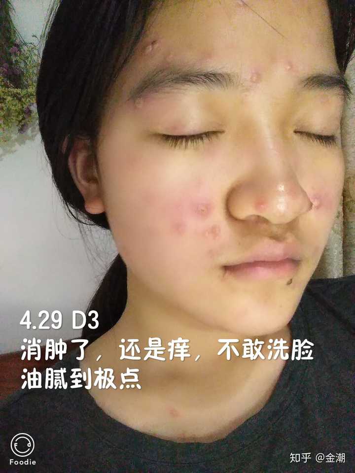 成人长水痘是什么样的经历?