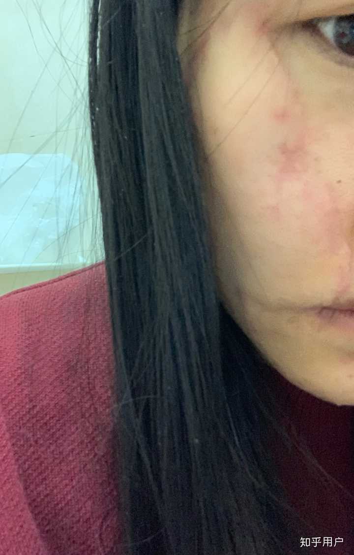 女生脸上有疤是怎样的体验?
