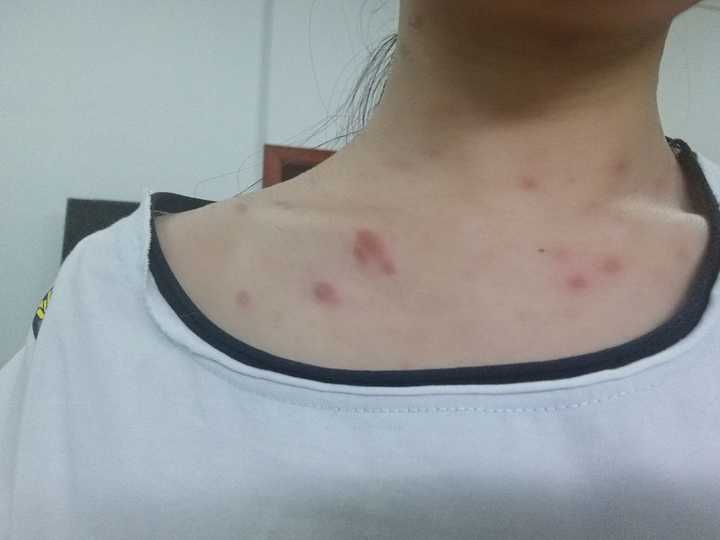 涂了阿昔洛韦软膏也没用,真的是控