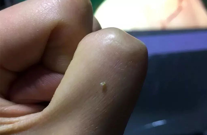 闭口是可以挤出小芝麻粒大小,淡黄色的脂肪栓的,而单纯的毛周角化