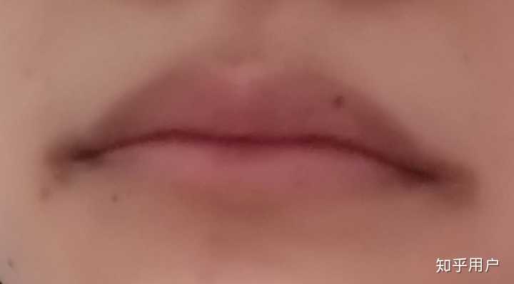 如何去除嘴角的黑色素?