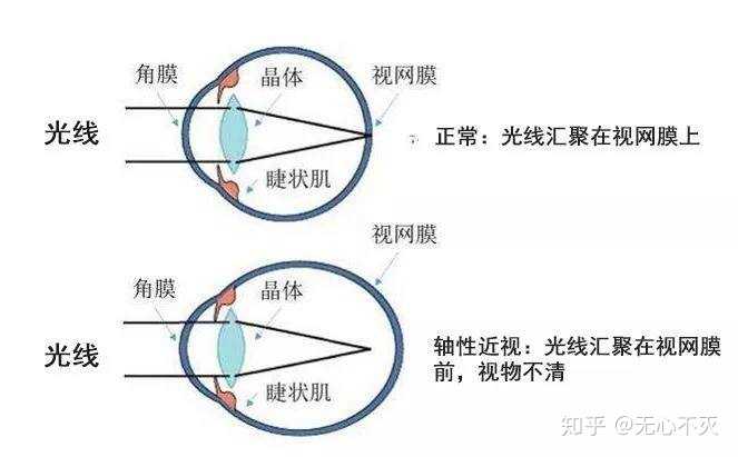 1,近视就是指在人眼睛调节放松状态下,平行光线经眼球屈光系统后聚焦