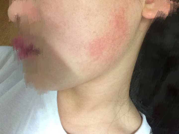 干皮 鼻子旁毛孔粗大 脸颊两边都泛着红血丝 角质层很薄 要怎么护理?