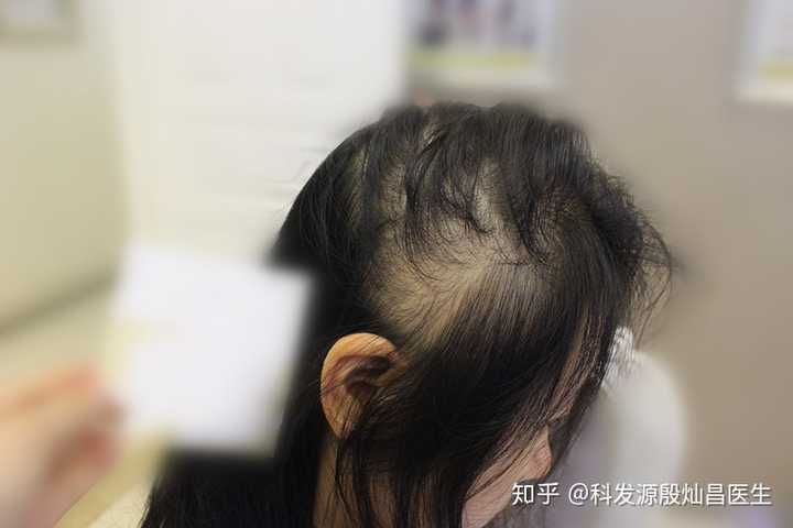 工作用脑过度,真的会掉头发吗?掉头发和用脑究竟有什么联系呢?