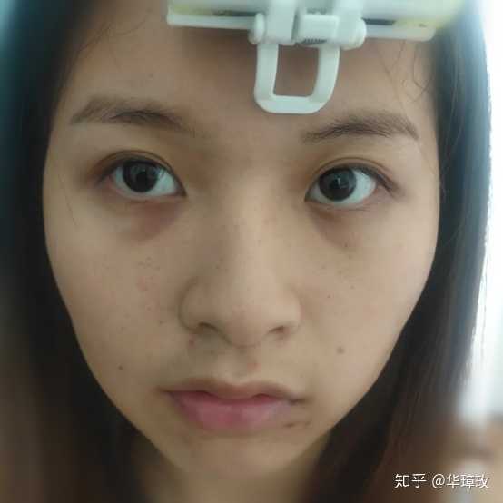 17岁黑眼圈超级重,很自卑,怎么办?