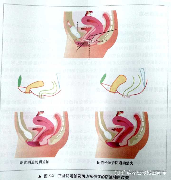 对于女性私密整形分日常的私密养护,比基尼脱毛,乳晕/阴唇褪黑嫩红