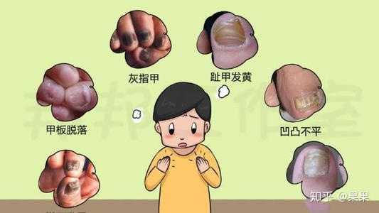 我的脚趾头这样是灰指甲吗