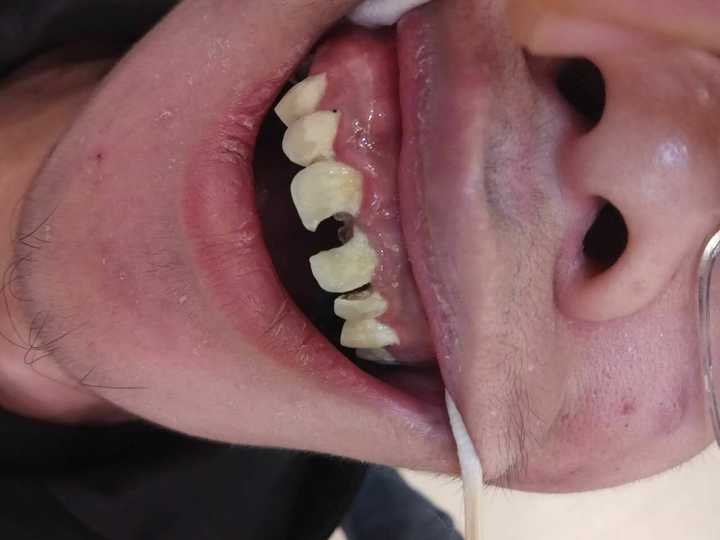 牙医碰见最烂的牙有多烂?