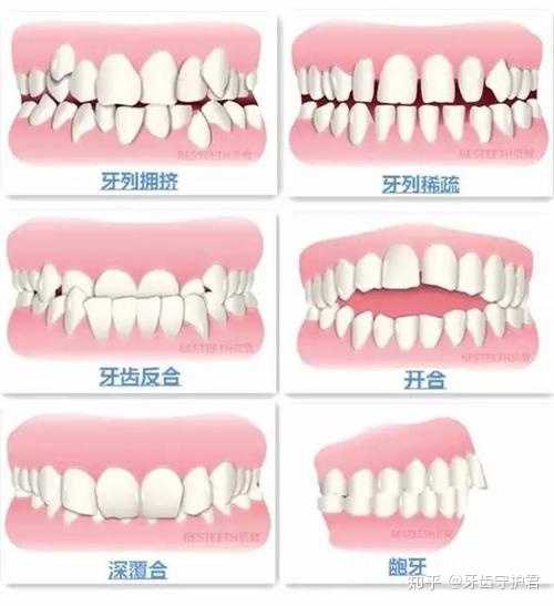 上下门牙以及上下颌骨向前突进,放松状态下上下唇多不能自然闭合,笑时