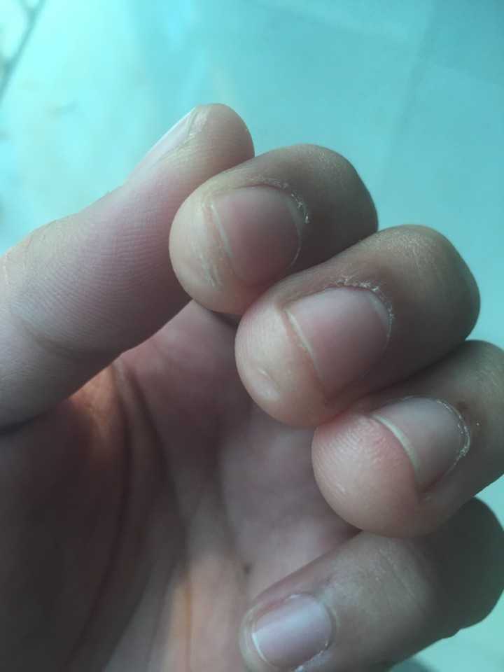 吉他对手指的伤害?