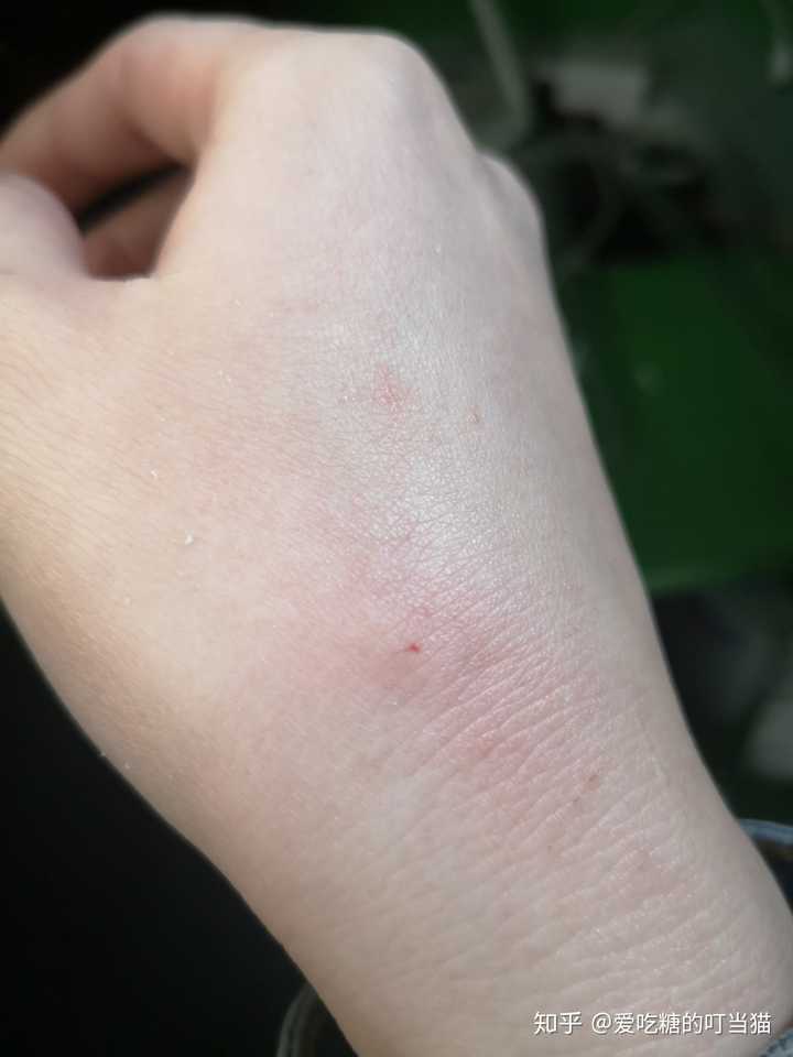 20天前被家里的猫咬了一小口,出血,现在去打疫苗还有用吗?