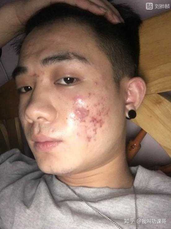 然后就会开始结痂掉痂,这个时候是千万不能用手去扣的哦 给大家看一