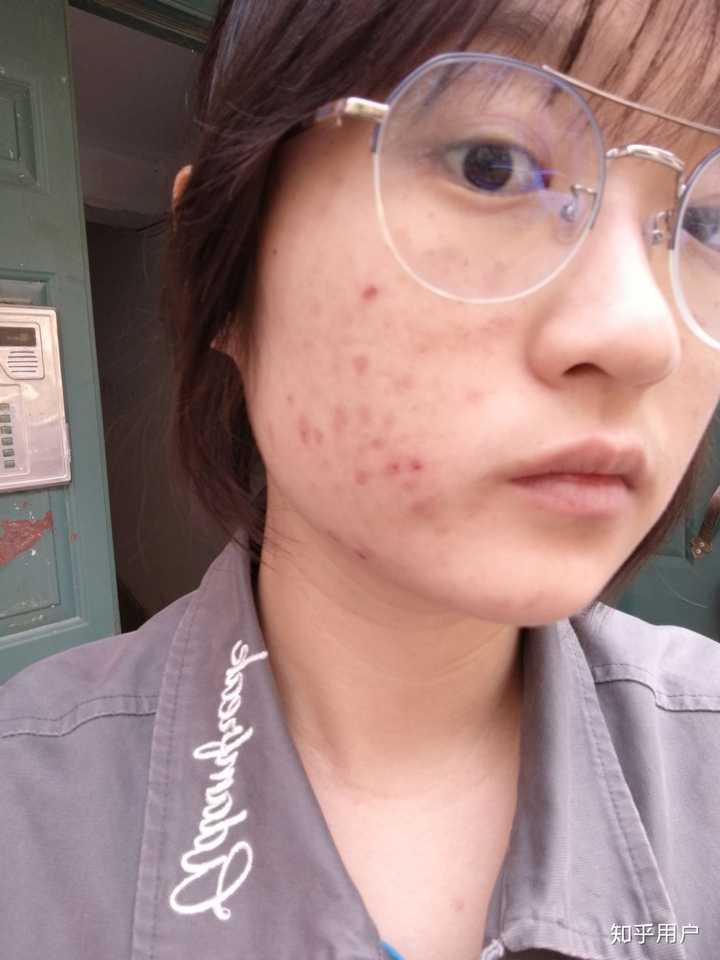 皮肤从满脸痘痘到白里透红是什么体验?