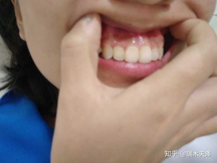 上牙龈也是凸起的比较厉害 所以侧面来看凸起还是很严重.