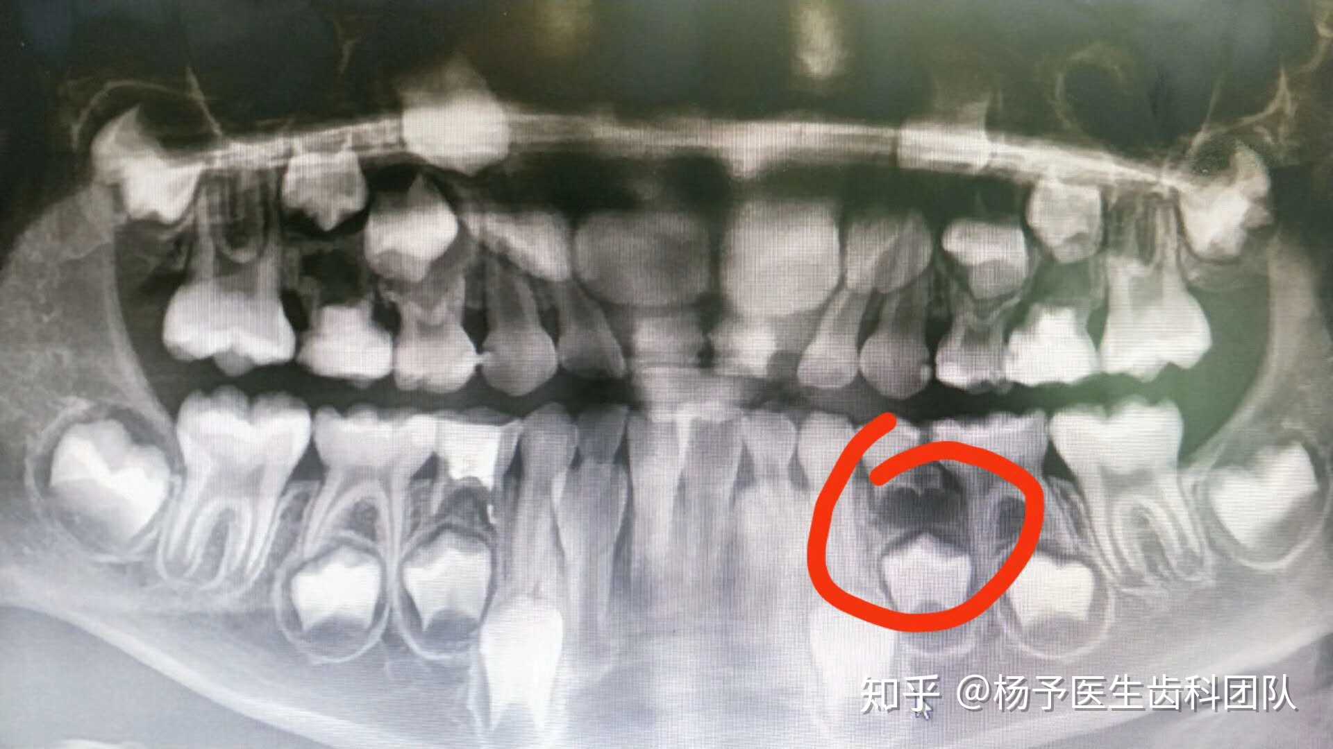 这个"小病号",年仅5岁,由于乳牙的龋… - 知乎