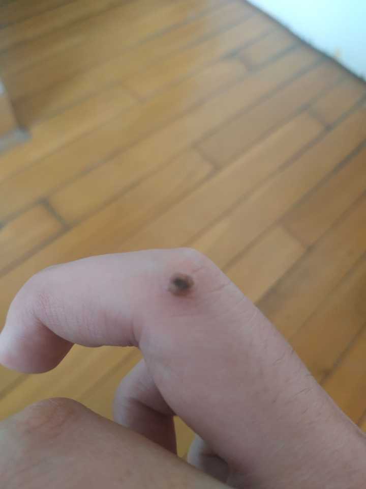 请问这个是瘊子吗?具体怎么治好呢?
