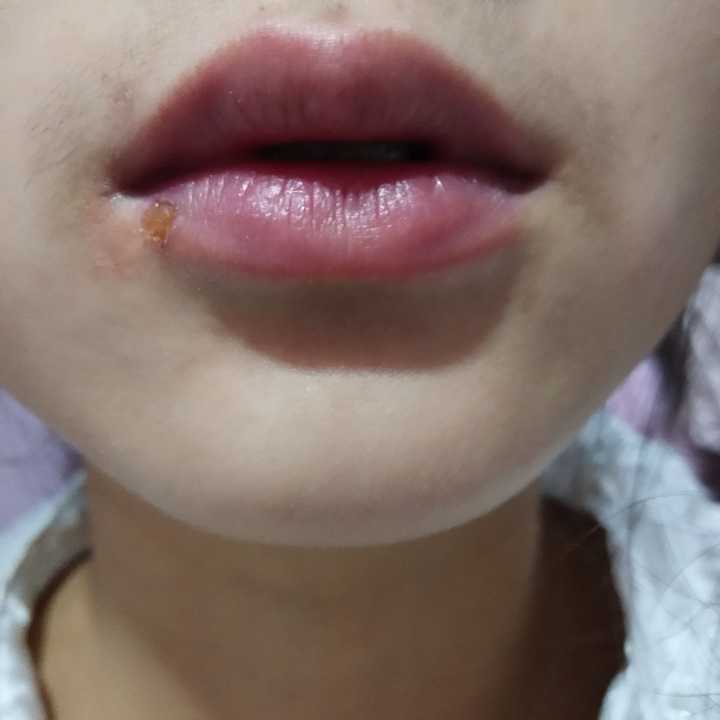嘴唇长疱疹怎么办?希望快点消失,那种方法见效快?