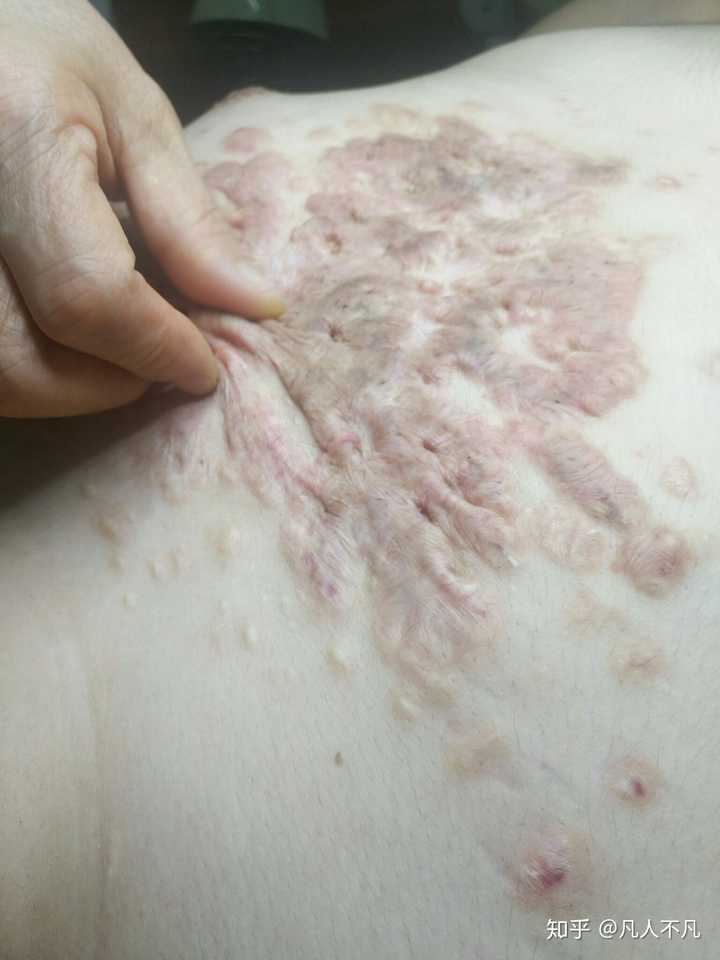 疤痕疙瘩是不是治不好?