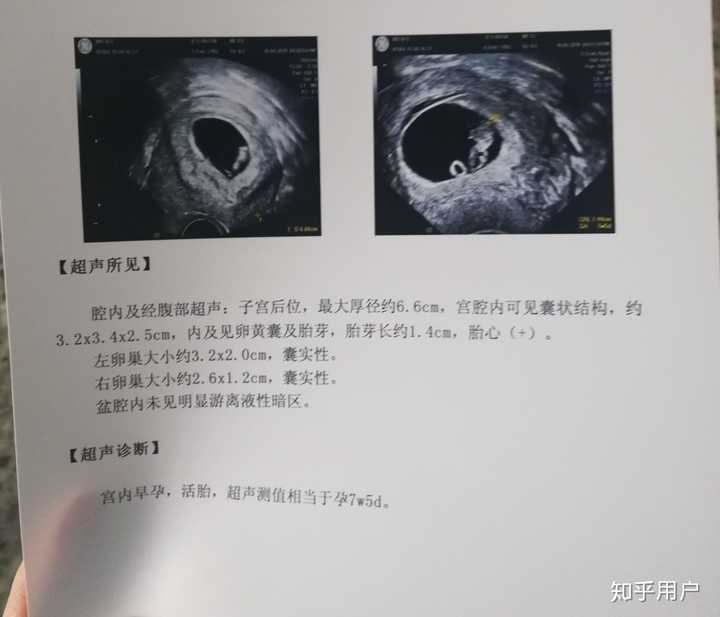 经历无痛人流全过程及术后会有什么感想?